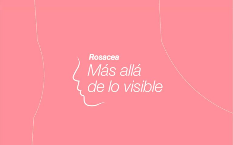 roseacea 1