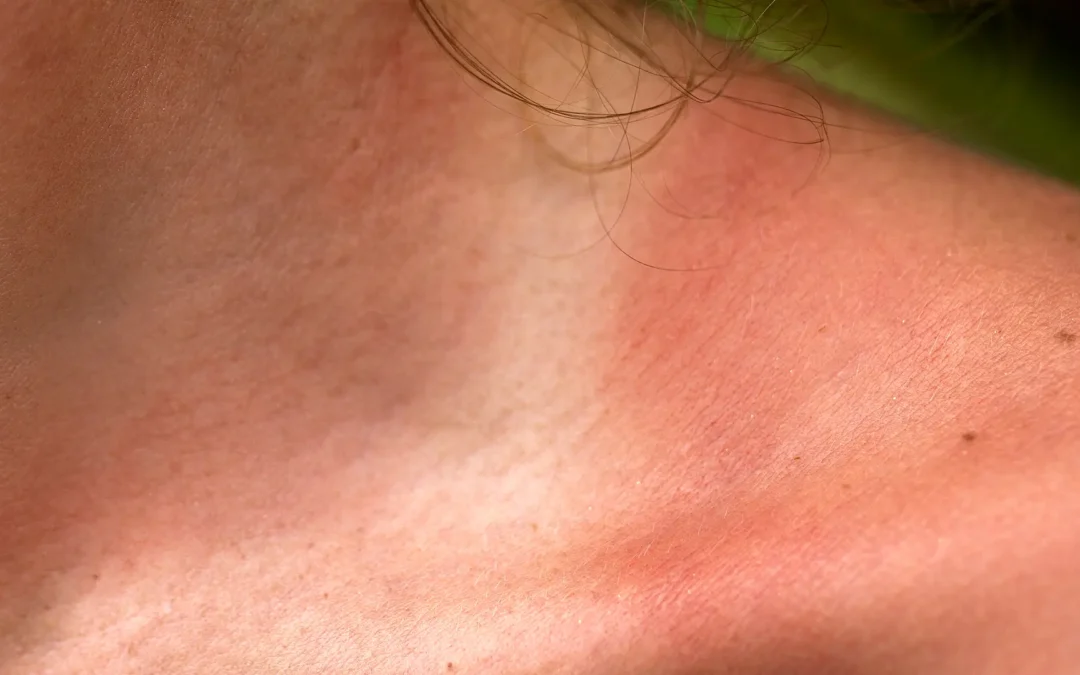 Piel atópica: cómo identificarla y los cuidados esenciales para mejorar la calidad de vida