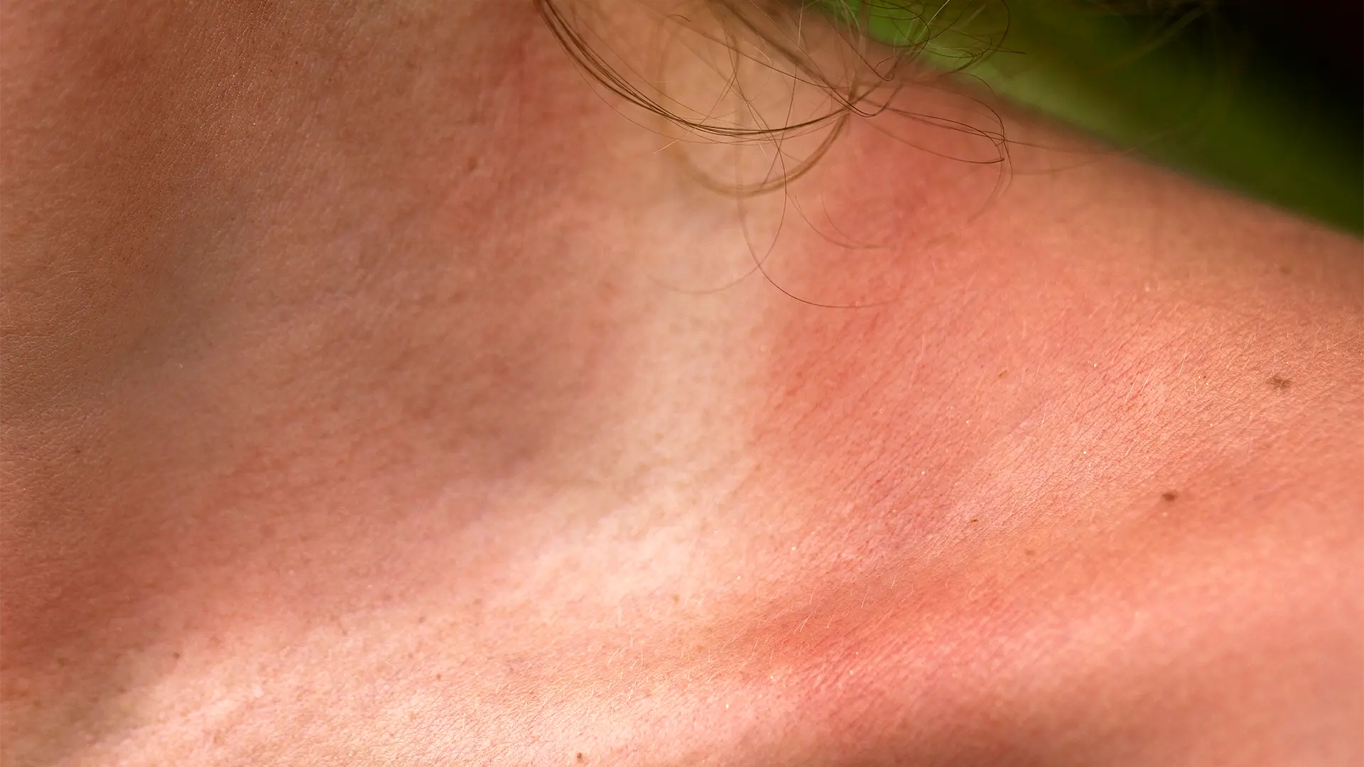 Piel atópica: cómo identificarla y los cuidados esenciales para mejorar la calidad de vida